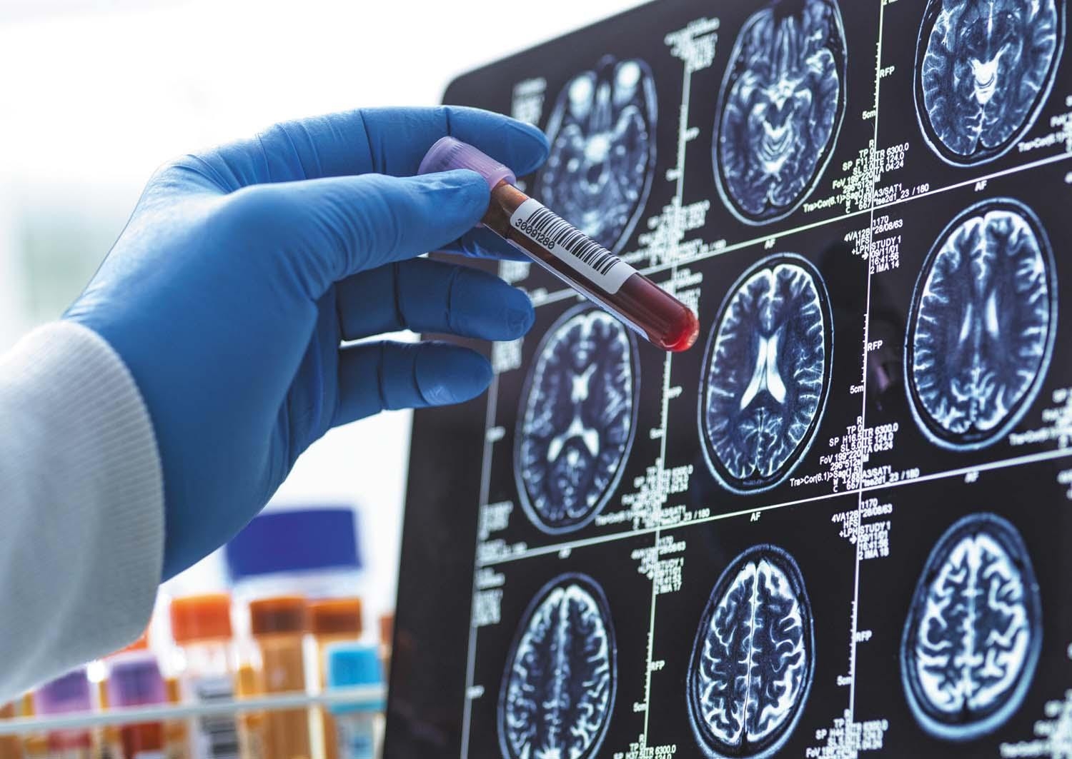 Bio-Hermes-002 и рана дијагностика на Алцхајмерот: потенцијалот на крвните тестови